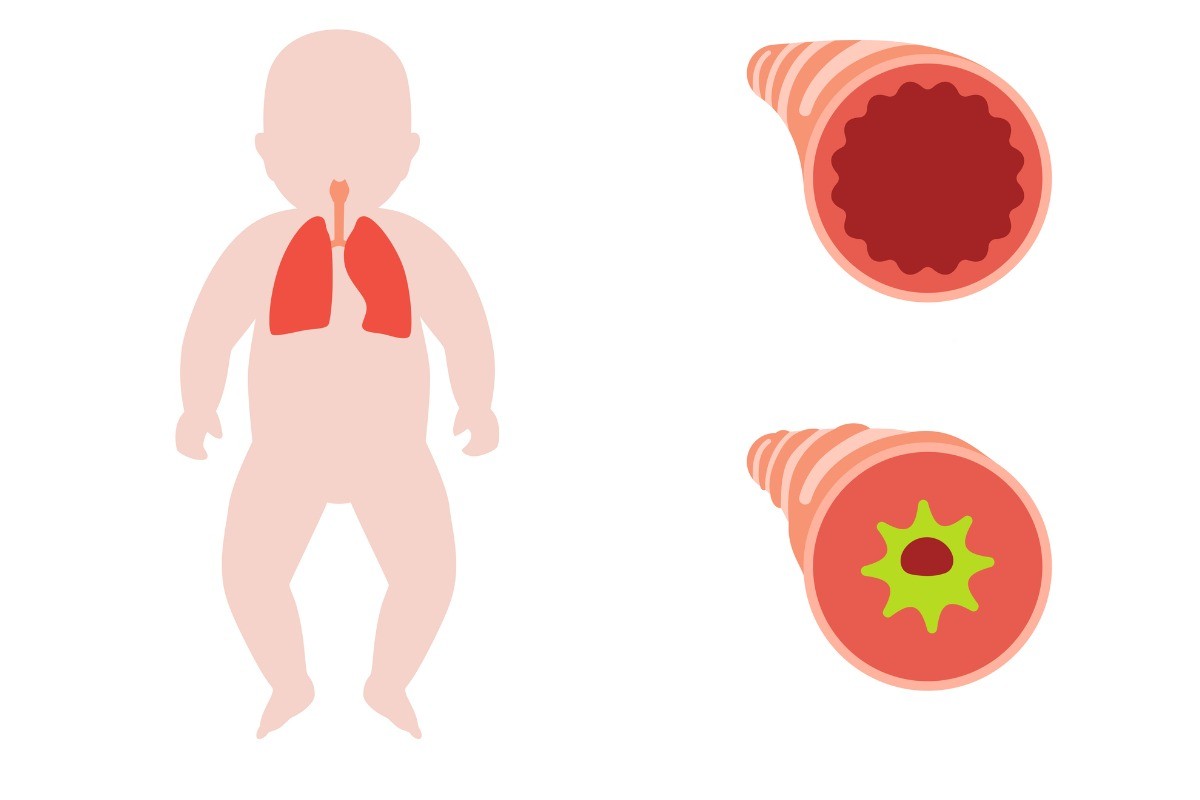 Ilustração mostrando a bronquiolite em bebês. A imagem inclui um diagrama de um bebê com os pulmões destacados, e duas seções transversais das vias aéreas, uma normal e outra estreitada devido à bronquiolite. 